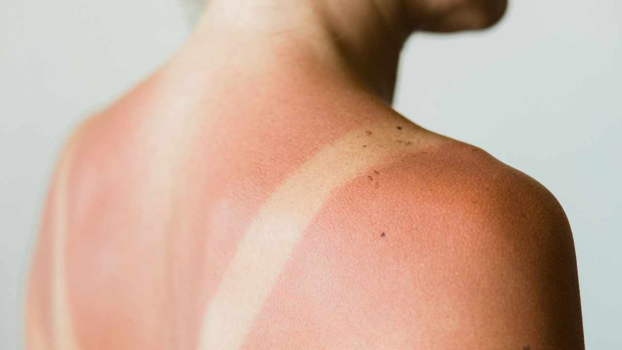 image of women sunburn shoulder